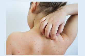 ढोरपाटनमा फैलिएको दादुरा अझै नियन्त्रणमा आएन